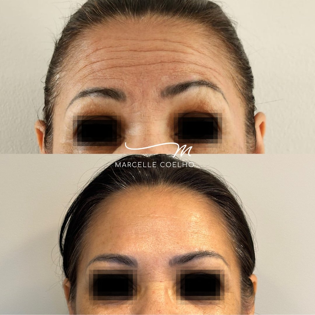 Botox (2)