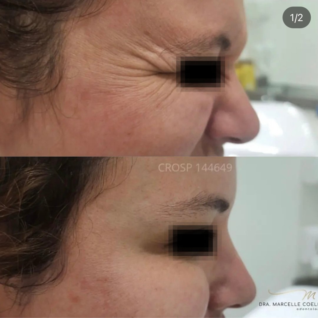 Botox (3)