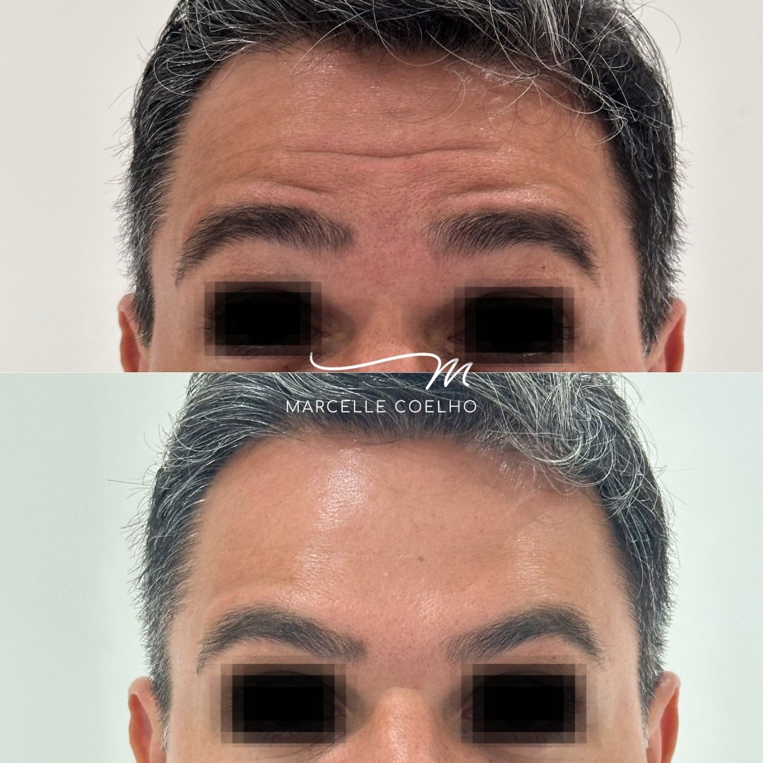 Botox (5)