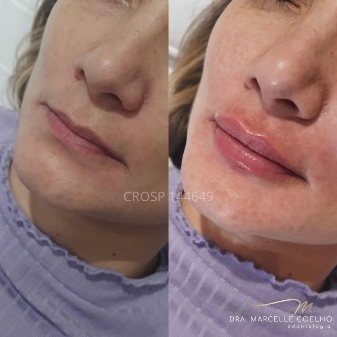 Preenchimento Labial (2)