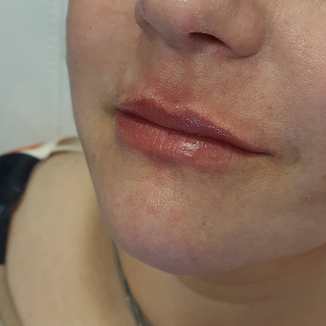 Preenchimento Labial (3)